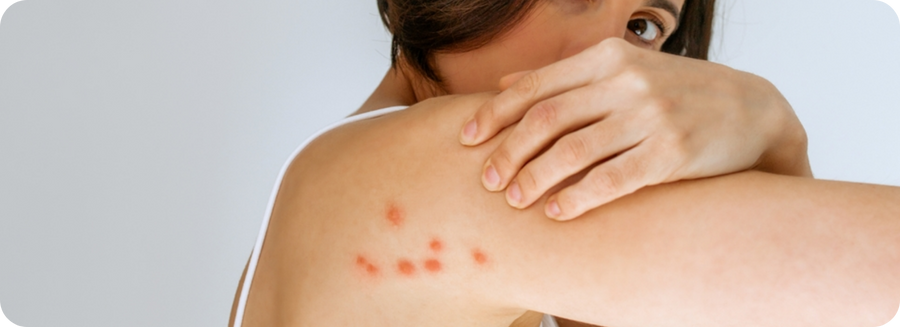 How To Treat Bed Bug Bites